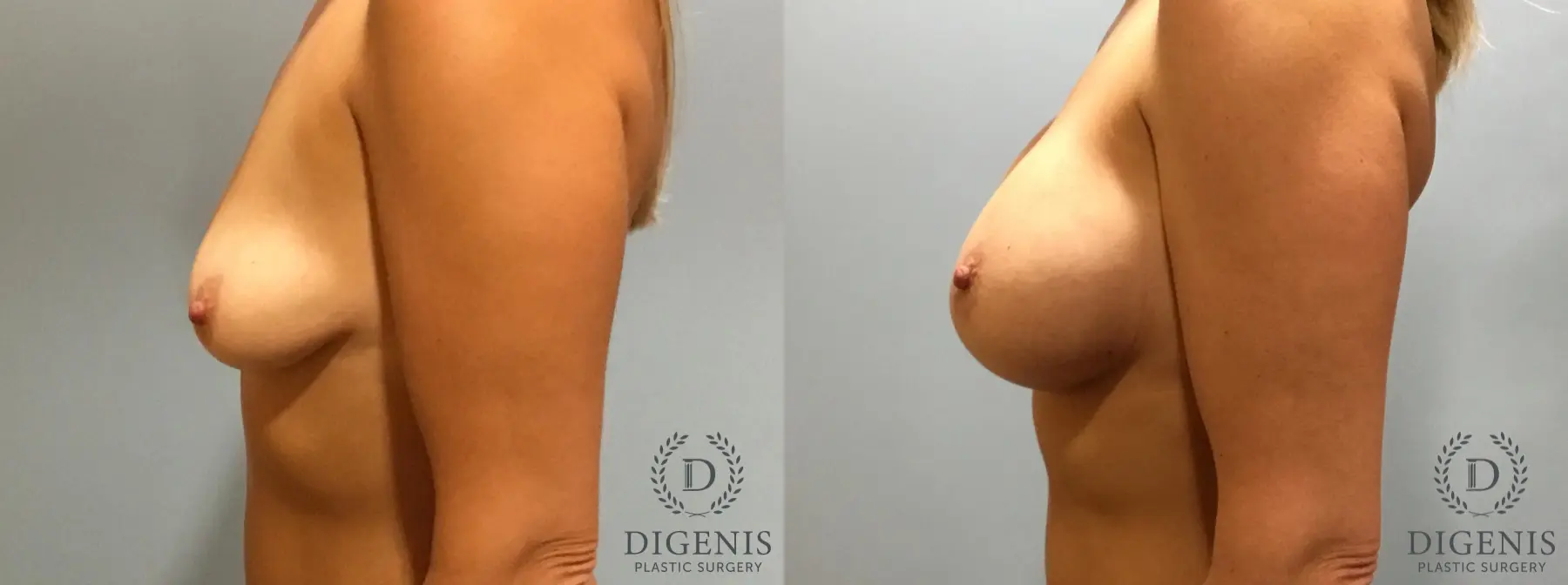 Breast Lift With Implants: Patient 5 - Before and After 5
