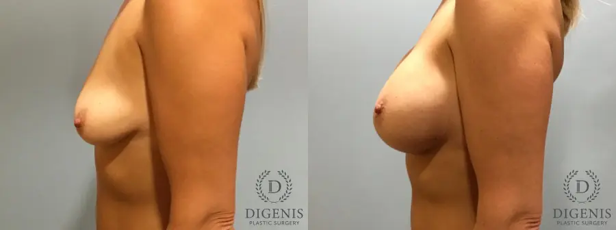 Breast Lift With Implants: Patient 5 - Before and After 5