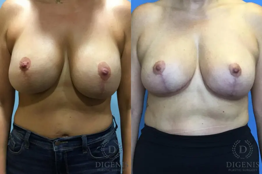 Breast Lift With Implants: Patient 2 - Before and After 1