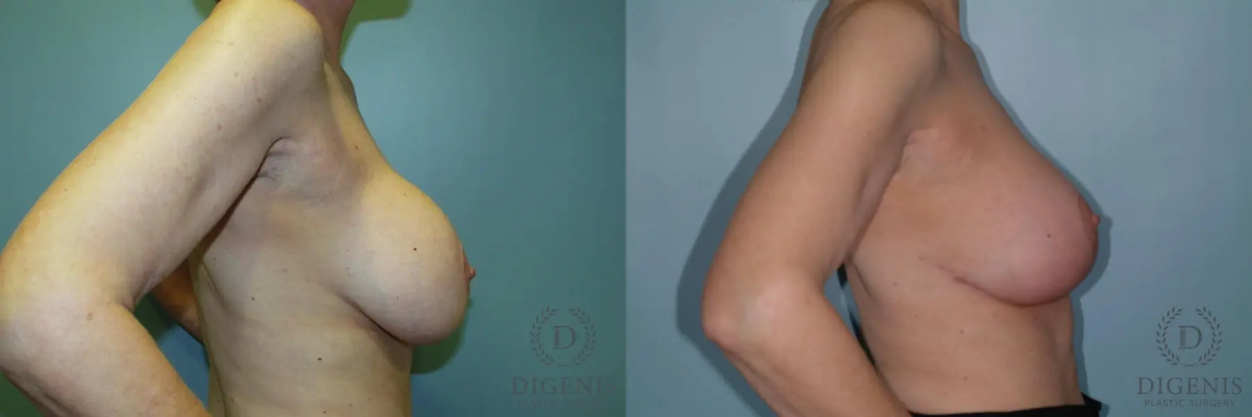 Breast Lift With Implants: Patient 6 - Before and After 3