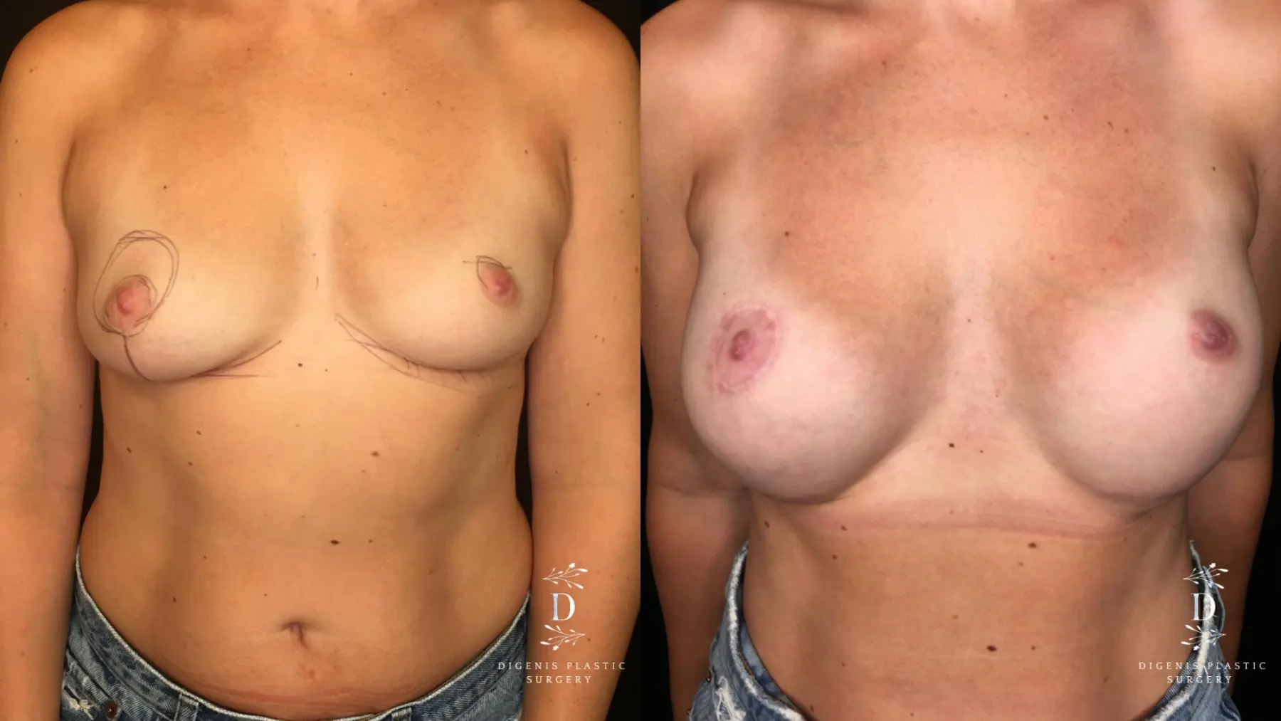 Breast Lift With Implants: Patient 10 - Before and After 1