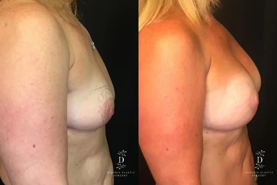 Breast Lift With Implants: Patient 8 - Before and After 3