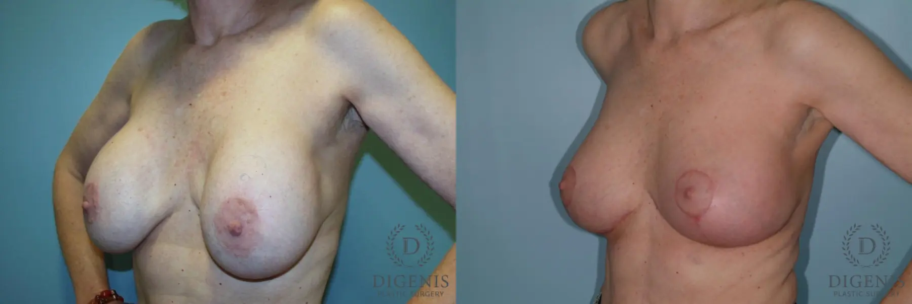 Breast Lift With Implants: Patient 6 - Before and After 4