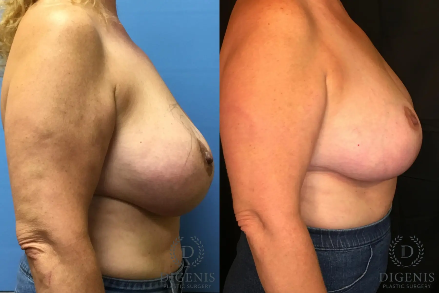 Breast Lift With Implants: Patient 4 - Before and After 3