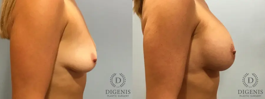 Breast Lift With Implants: Patient 5 - Before and After 3