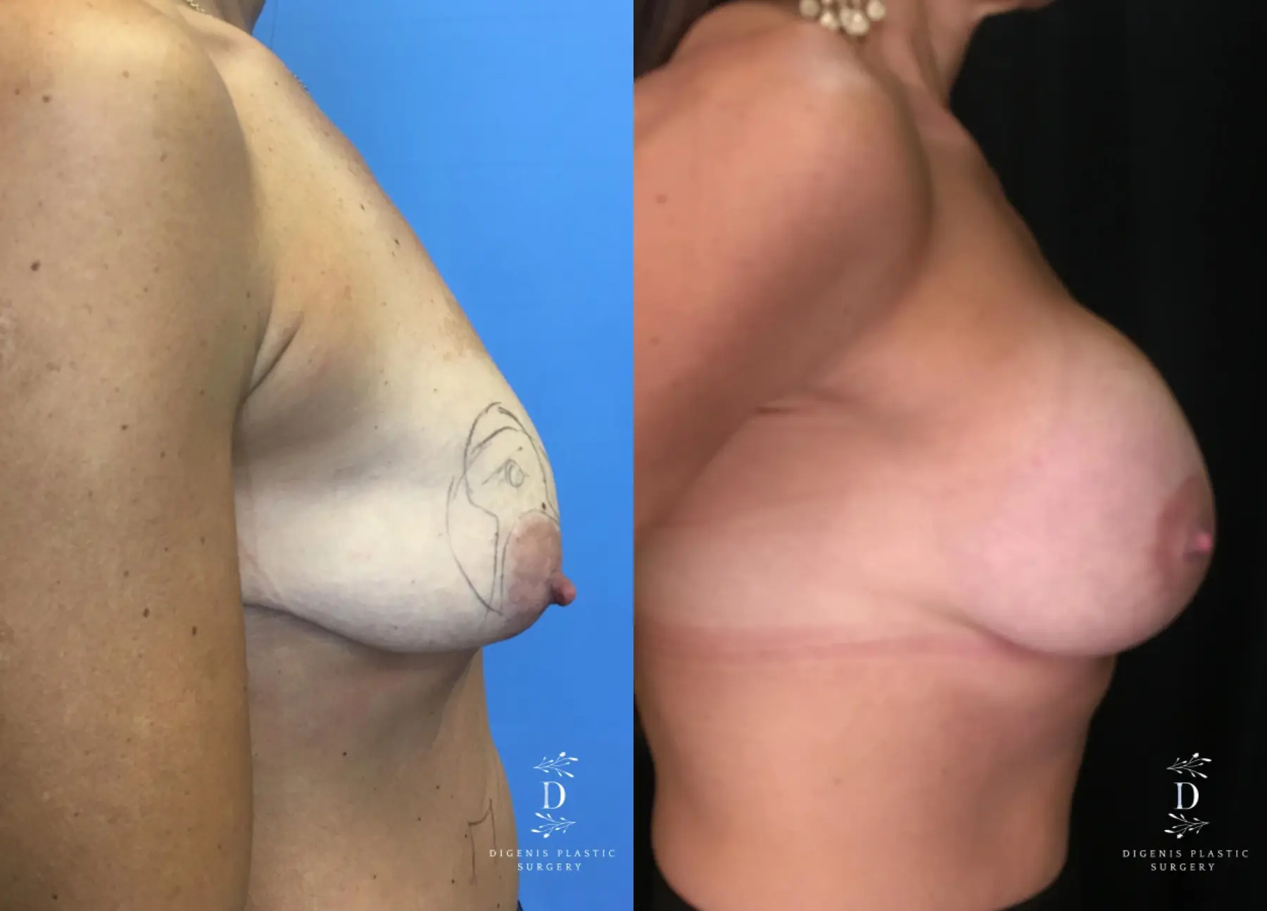 Breast Lift With Implants: Patient 13 - Before and After 3