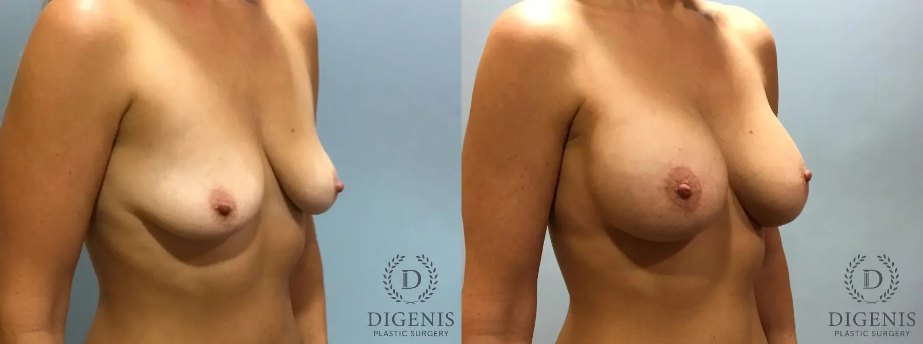 Breast Lift With Implants: Patient 5 - Before and After 2