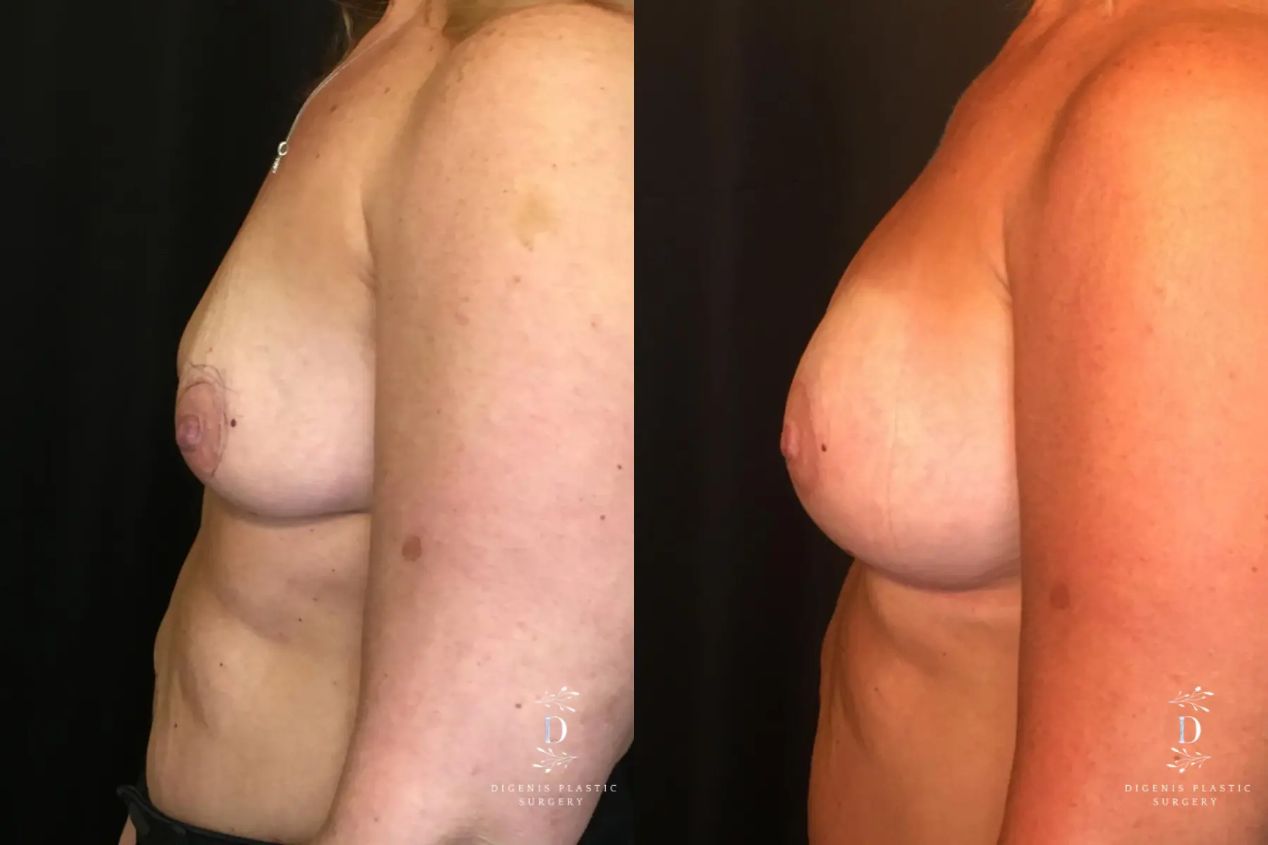 Breast Lift With Implants: Patient 8 - Before and After 5