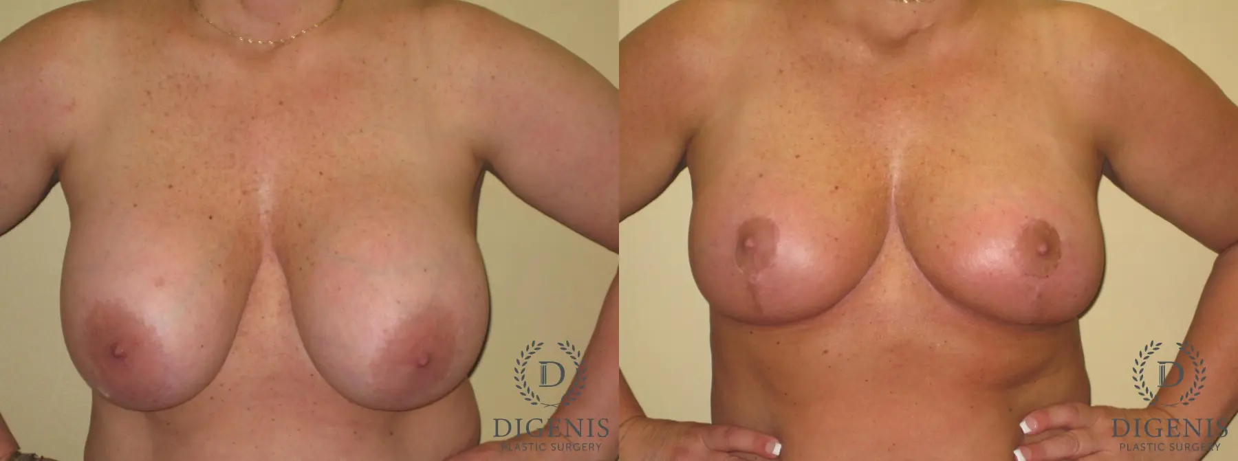 Breast Lift With Implants: Patient 7 - Before and After  