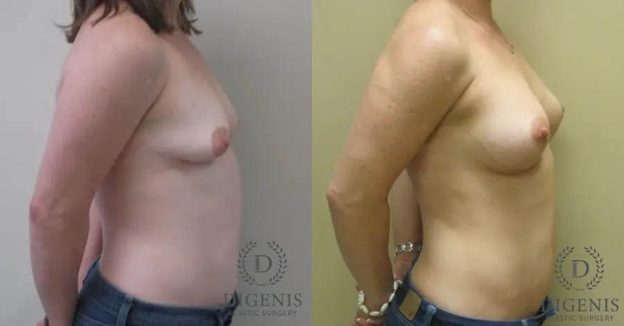 Breast Lift With Implants: Patient 1 - Before and After 3