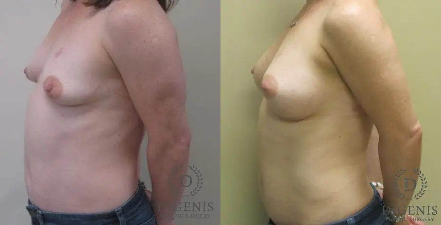 Breast Lift With Implants: Patient 1 - Before and After 5