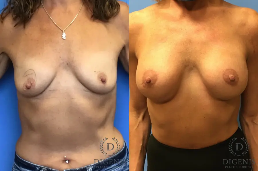 Breast Lift With Implants: Patient 3 - Before and After  