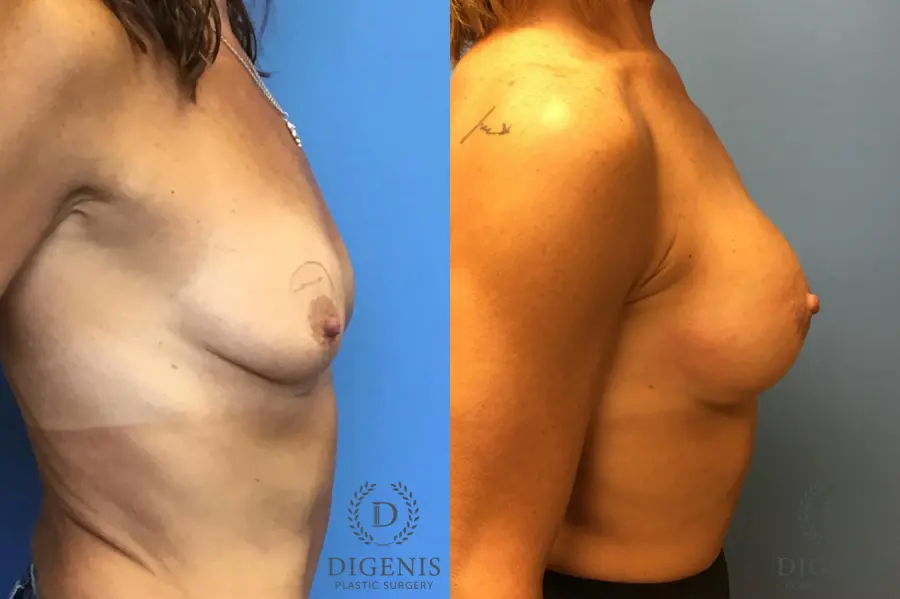Breast Lift With Implants: Patient 3 - Before and After 5