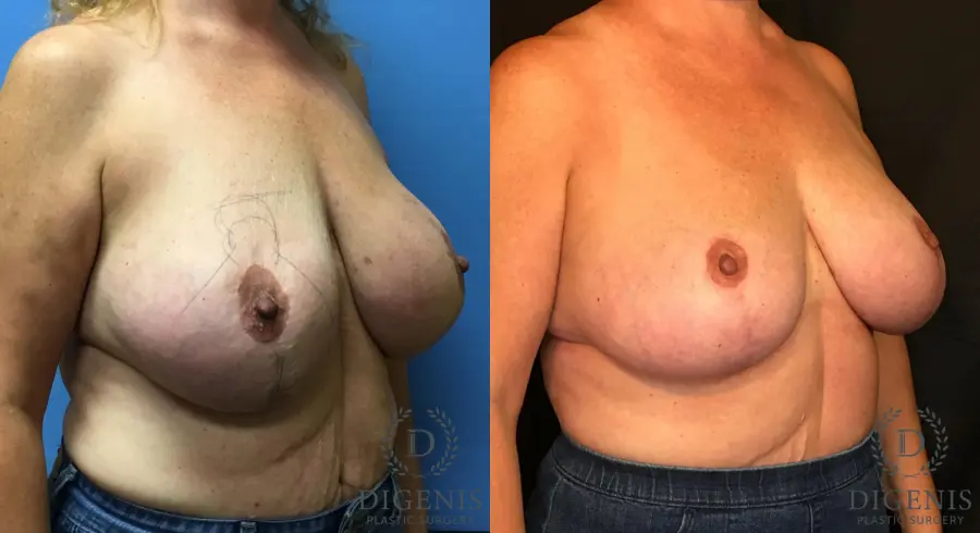 Breast Lift With Implants: Patient 4 - Before and After 2