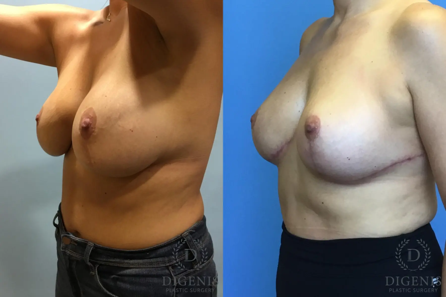 Breast Lift With Implants: Patient 2 - Before and After 2