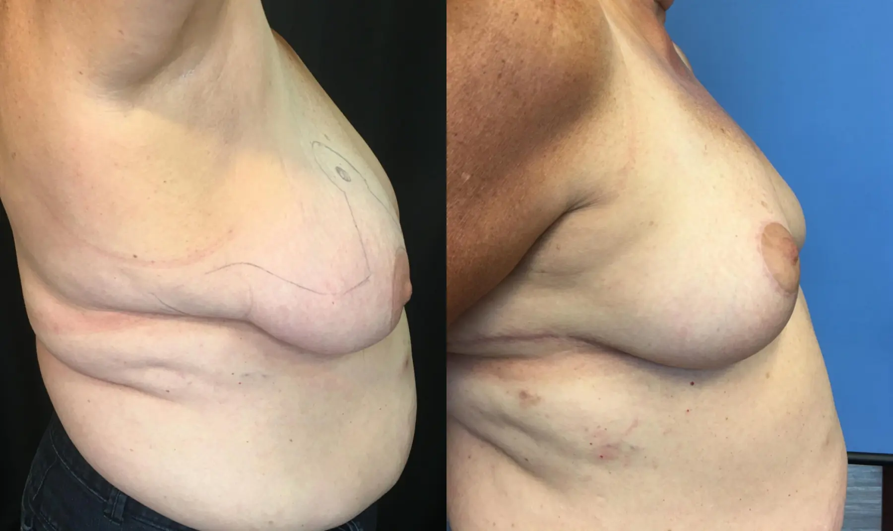 Breast Reduction: Patient 1 - Before and After 3