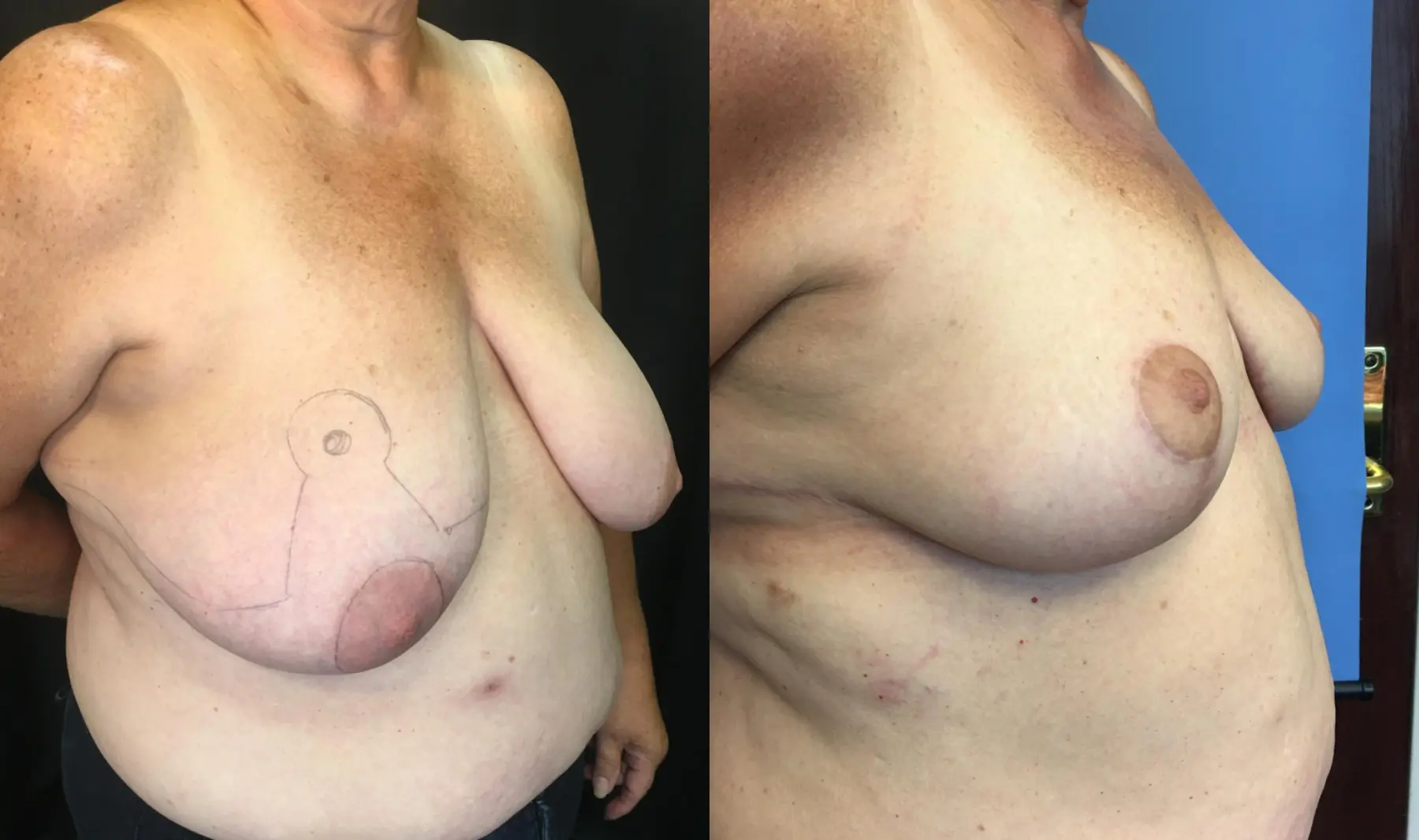 Breast Reduction: Patient 1 - Before and After 2