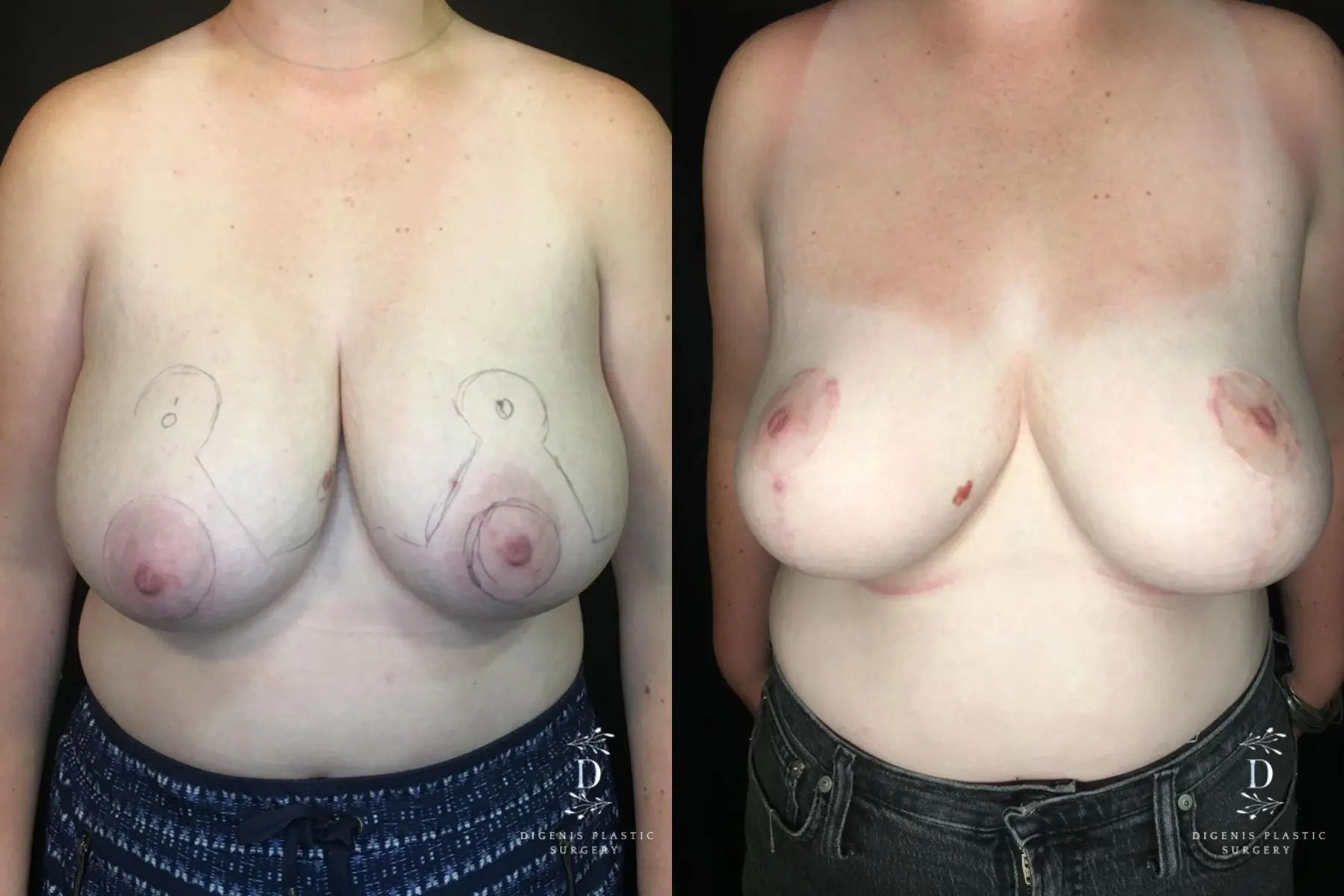 Breast Reduction: Patient 2 - Before and After  