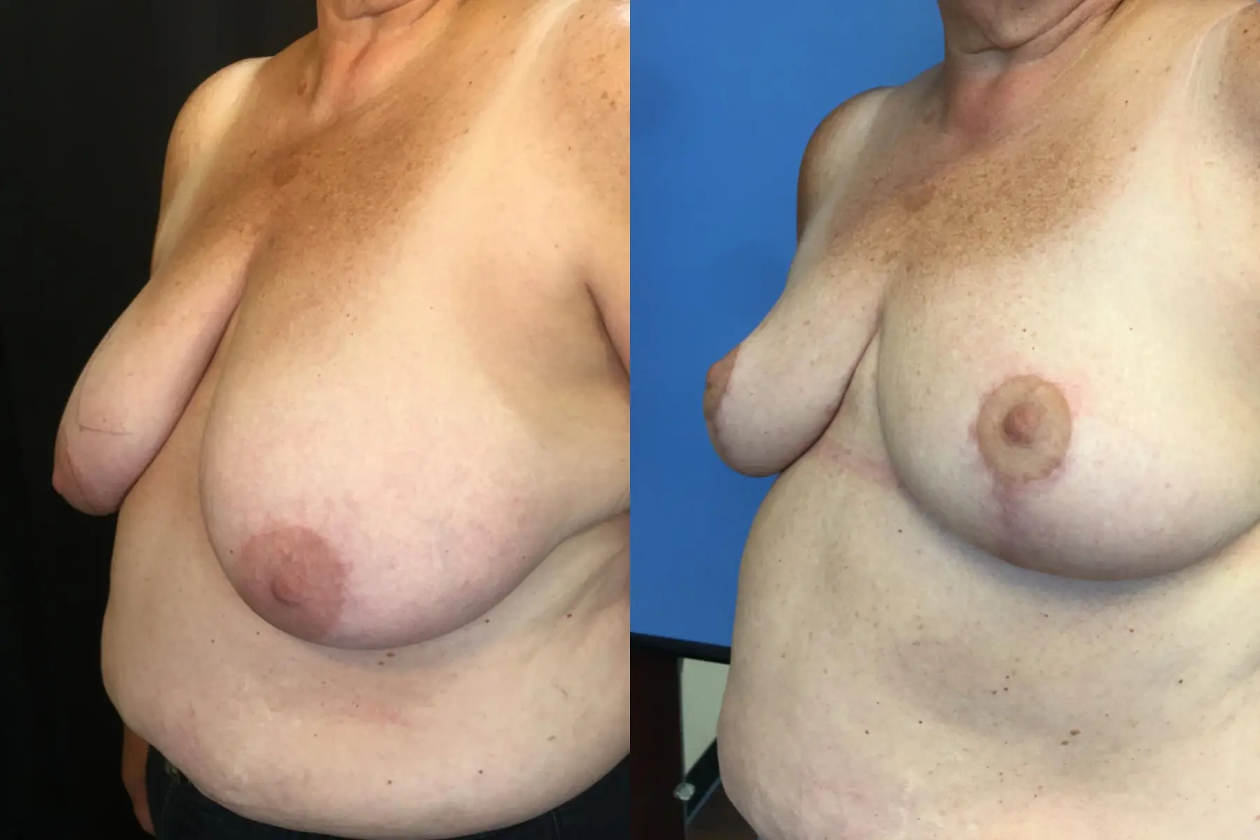 Breast Reduction: Patient 1 - Before and After 4