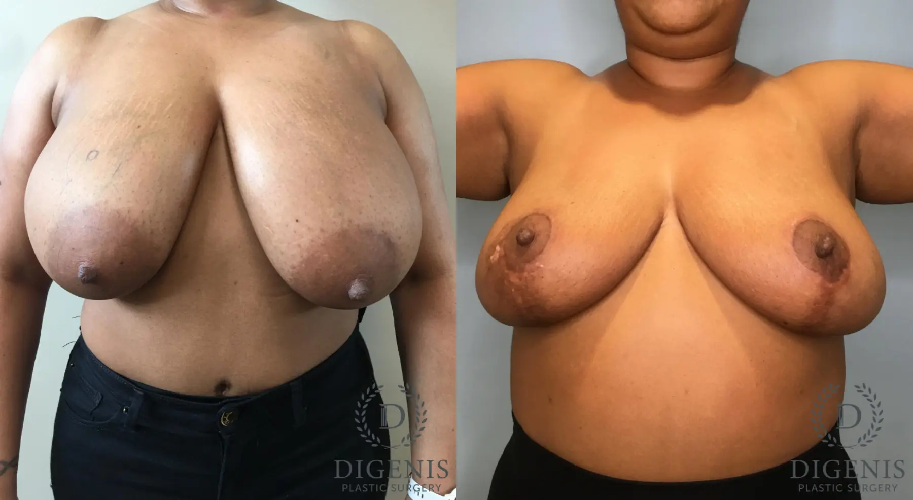 Breast Reduction: Patient 4 - Before and After  