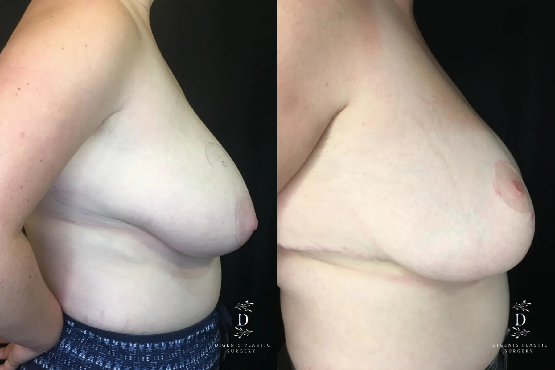 Breast Reduction: Patient 2 - Before and After 3