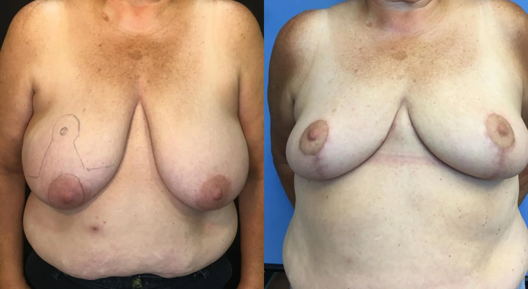 Breast Reduction: Patient 1 - Before and After  