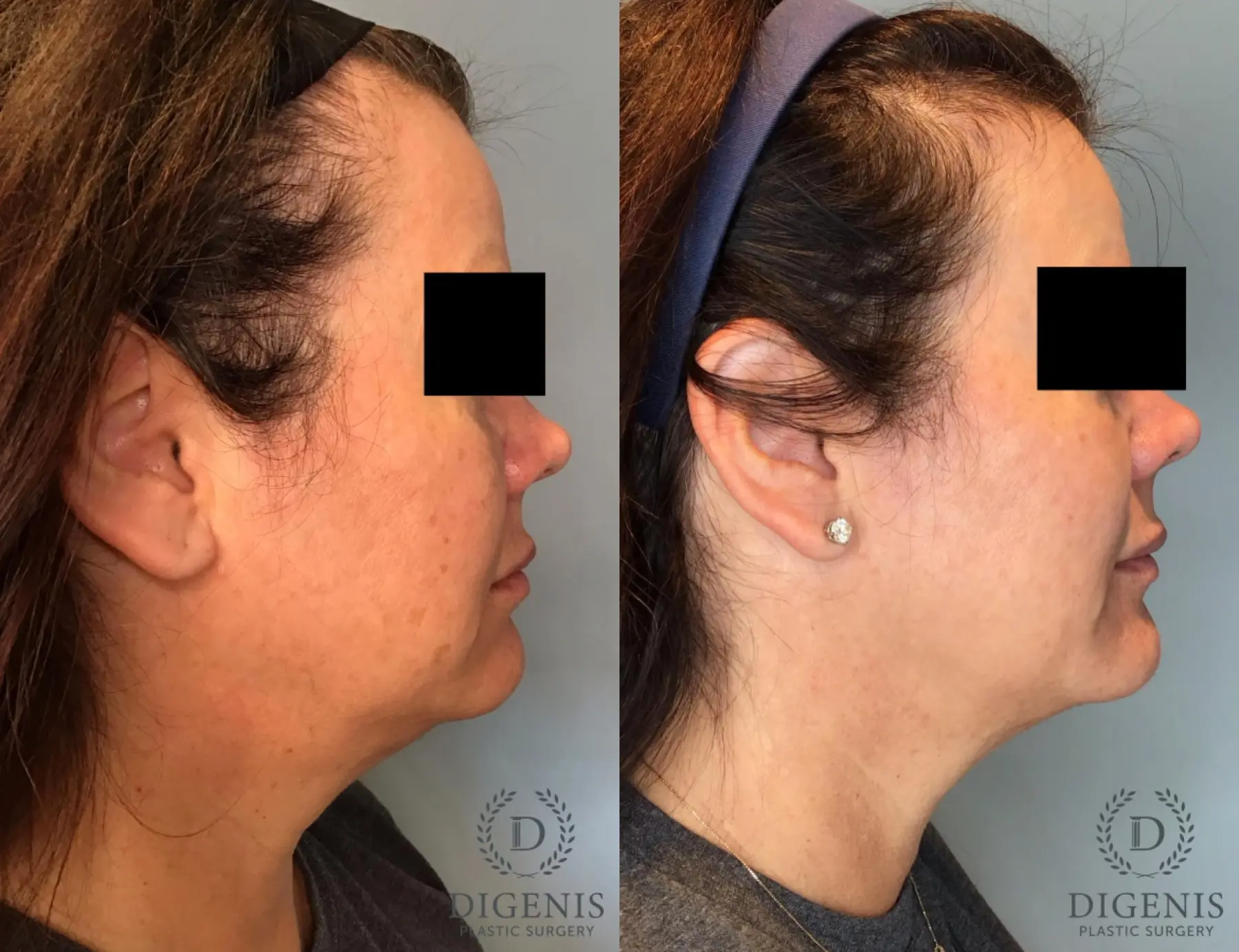 BroadBand Light (BBL™): Patient 1 - Before and After  