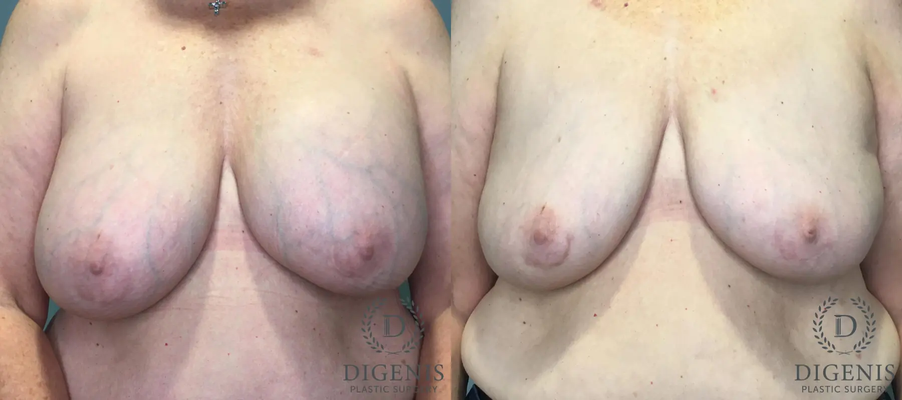 Combo Procedures - Breast: Patient 1 - Before and After  