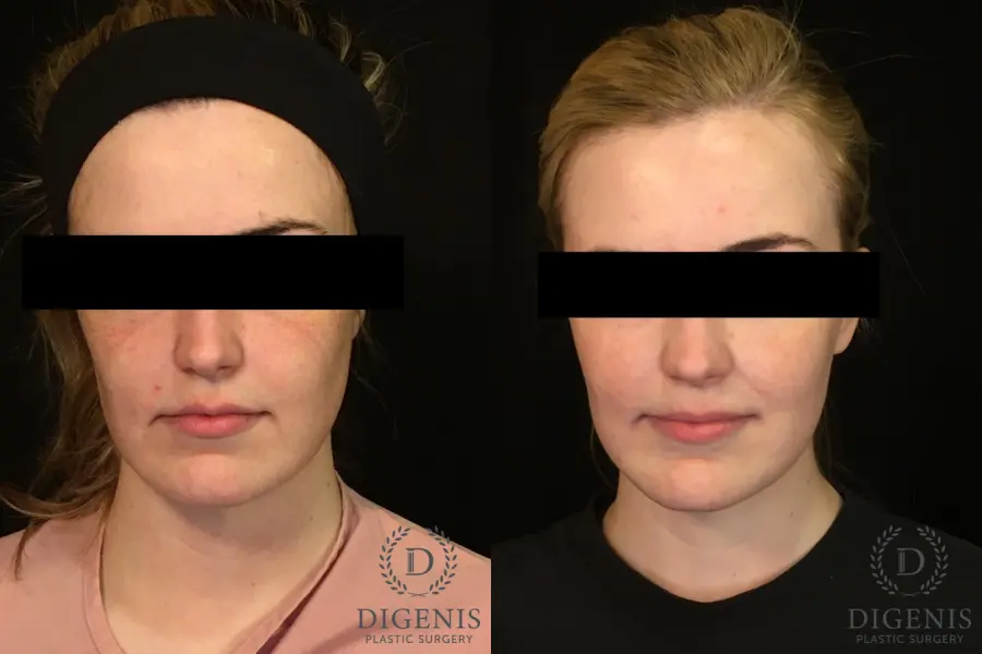Digenis Refresh Lift: Patient 2 - Before and After 1