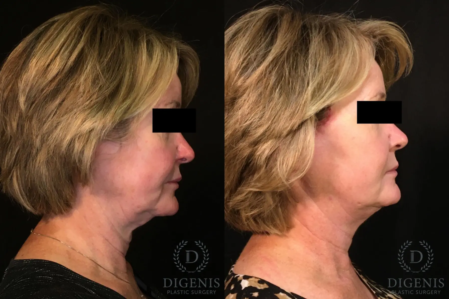 Digenis Refresh Lift: Patient 1 - Before and After 3