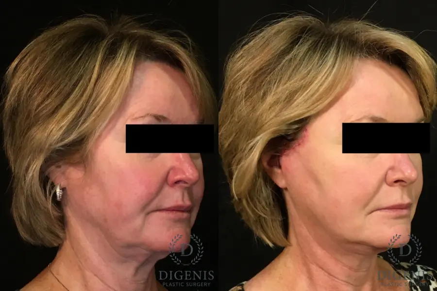 Digenis Refresh Lift: Patient 1 - Before and After 2