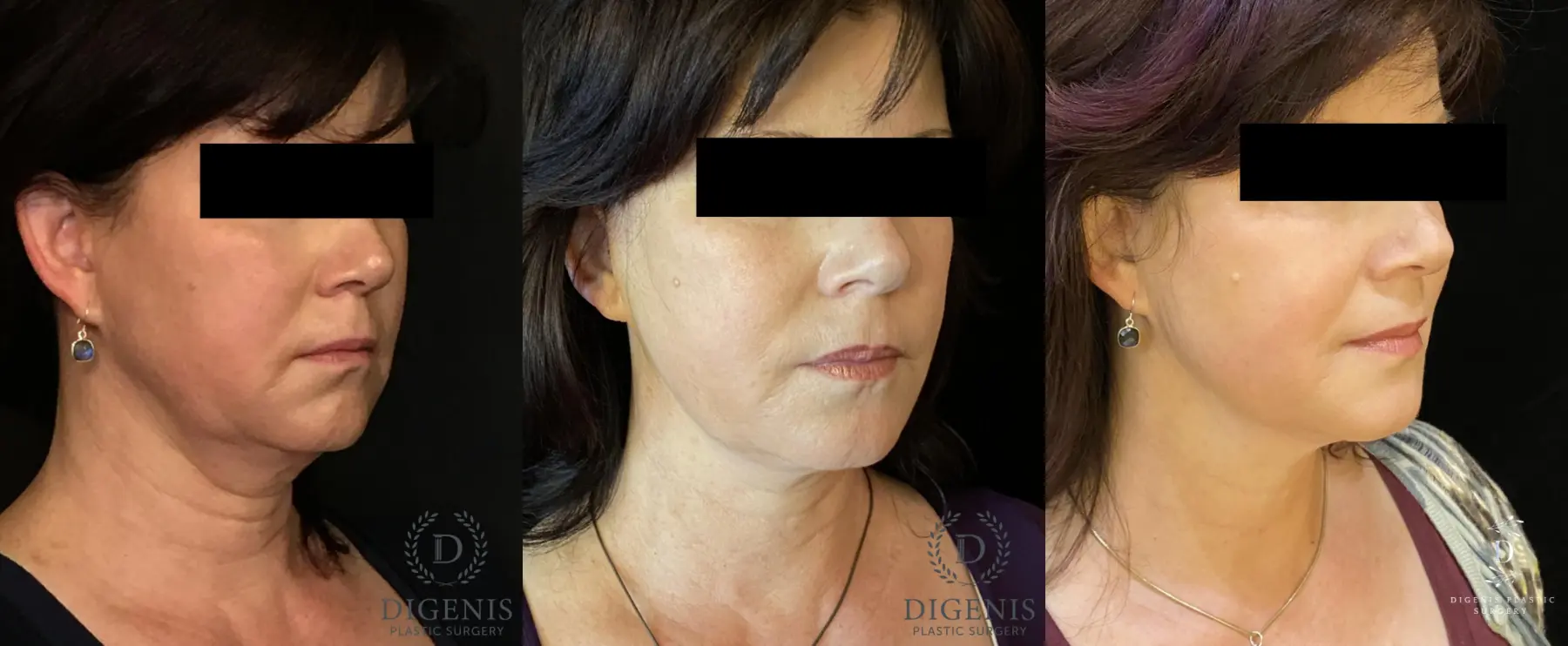 Digenis Refresh Lift: Patient 4 - Before and After 2