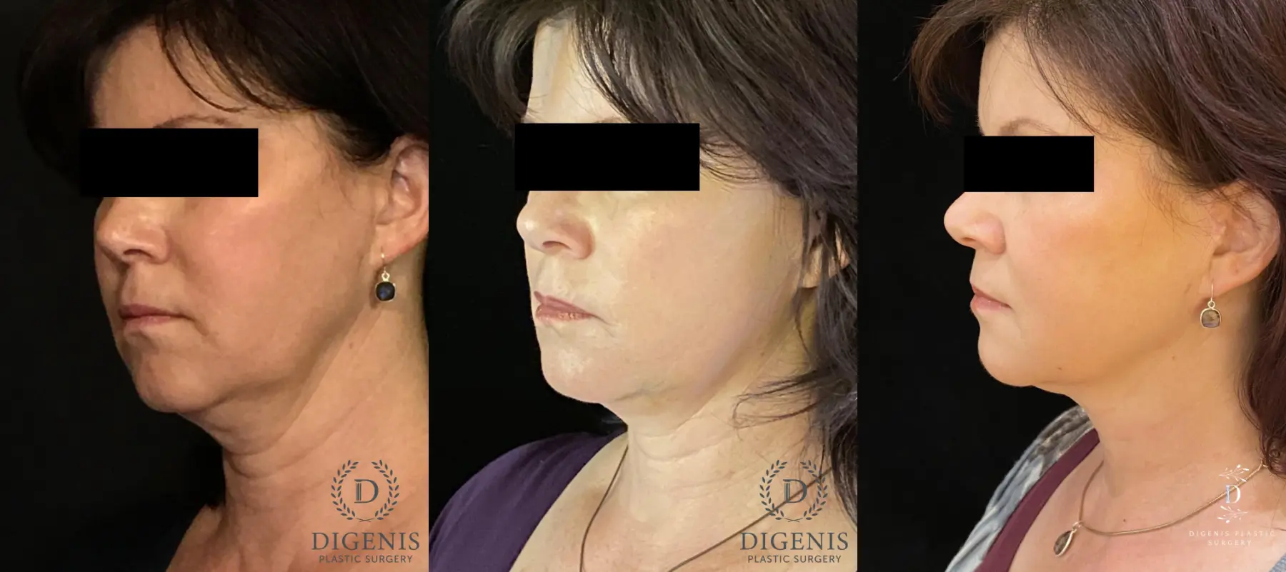 Digenis Refresh Lift: Patient 4 - Before and After 4