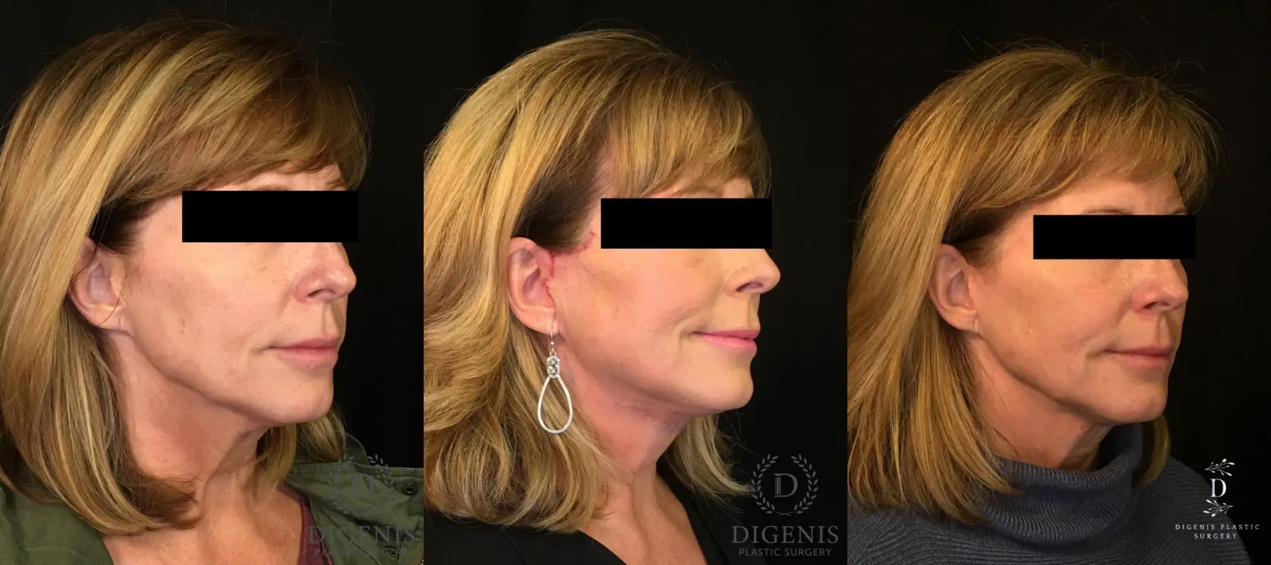 Digenis Refresh Lift: Patient 3 - Before and After 2