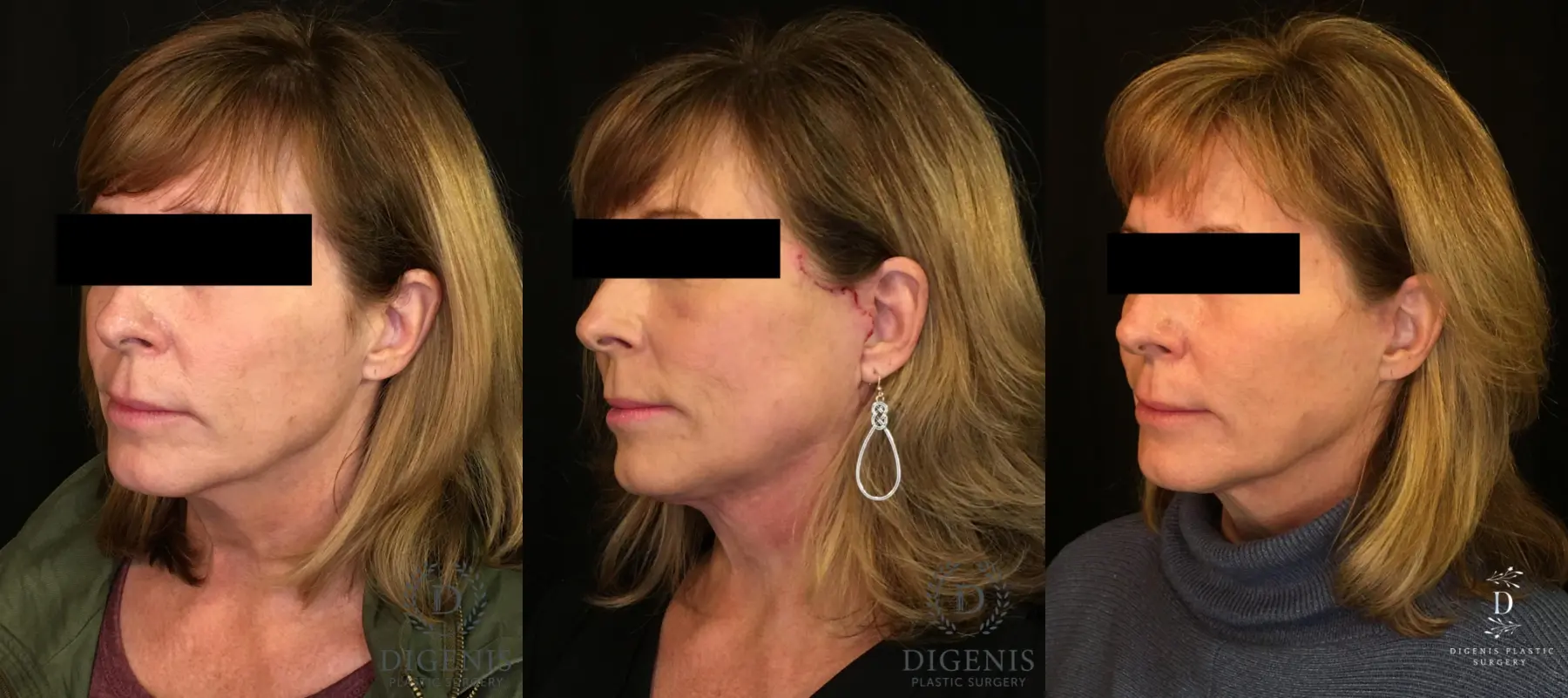 Digenis Refresh Lift: Patient 3 - Before and After 4