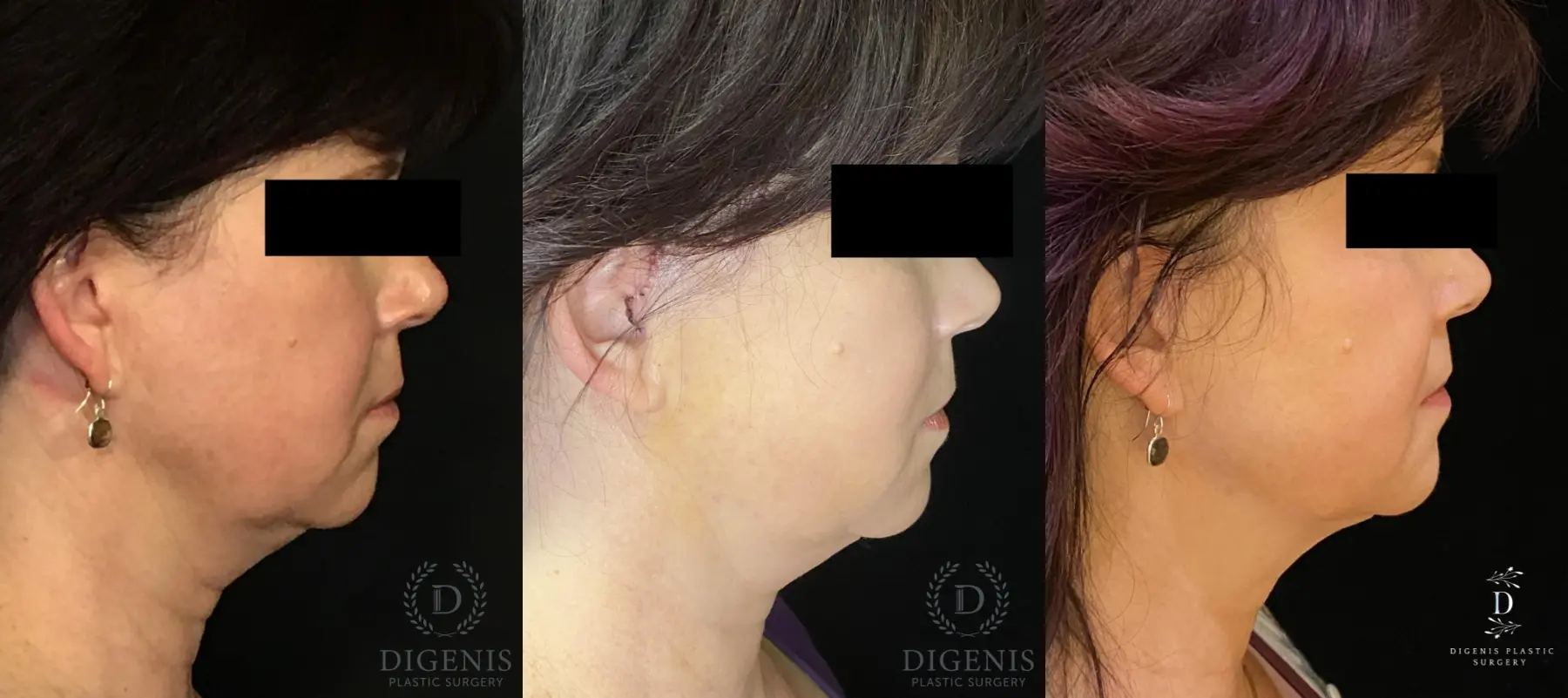 Digenis Refresh Lift: Patient 4 - Before and After 3