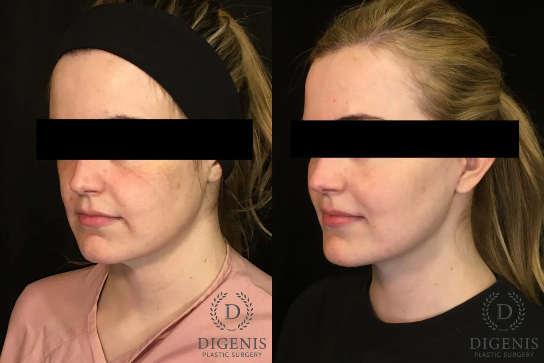Digenis Refresh Lift: Patient 2 - Before and After 2