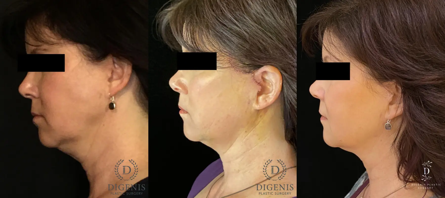 Digenis Refresh Lift: Patient 4 - Before and After 5