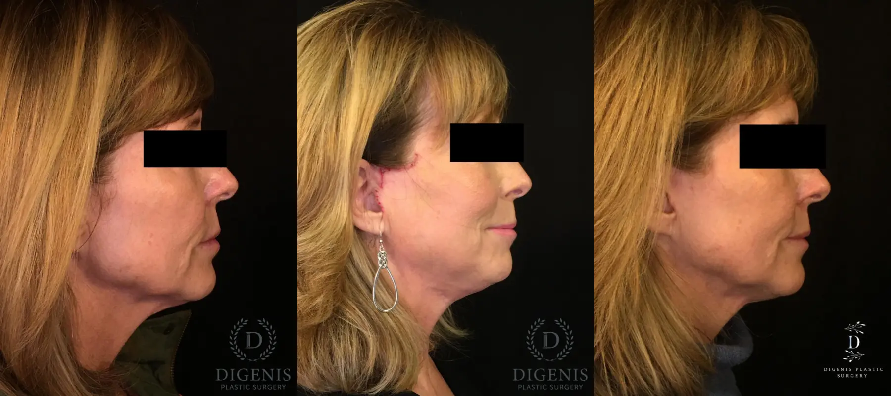 Digenis Refresh Lift: Patient 3 - Before and After 3