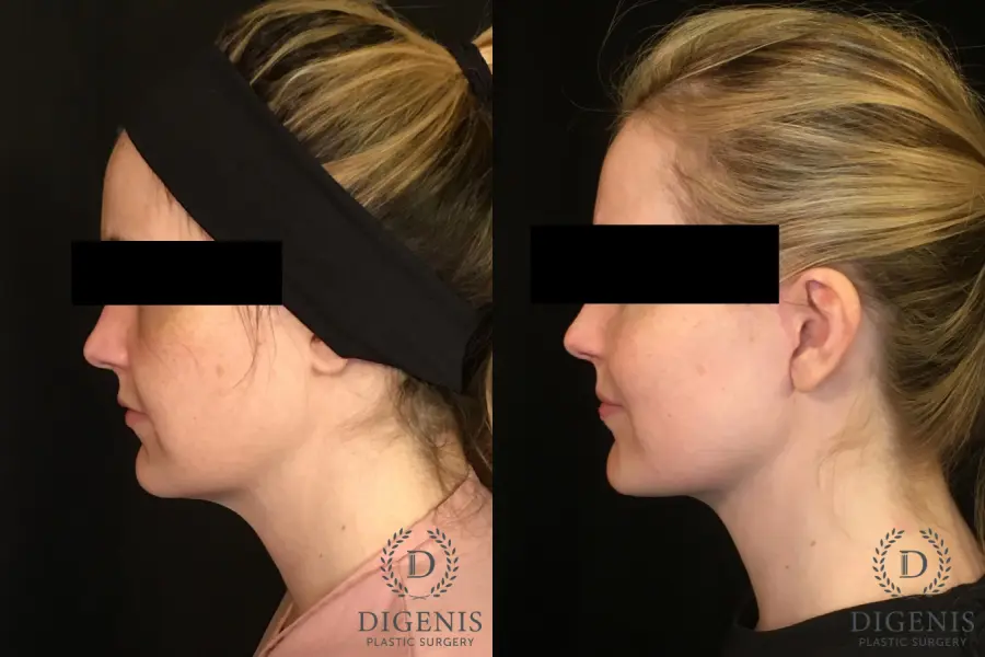 Digenis Refresh Lift: Patient 2 - Before and After 3