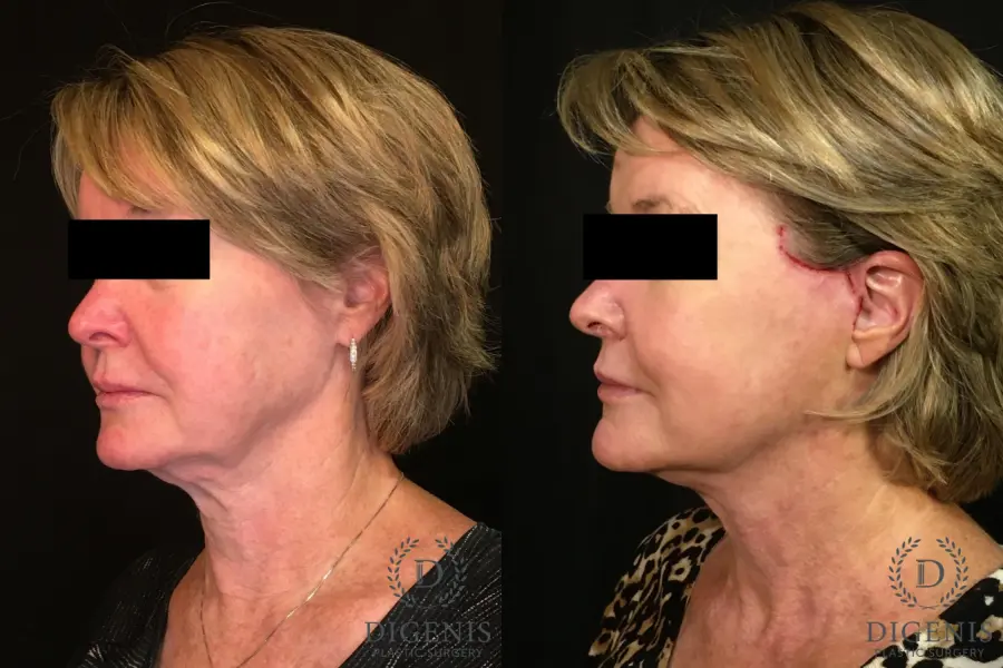 Digenis Refresh Lift: Patient 1 - Before and After 4