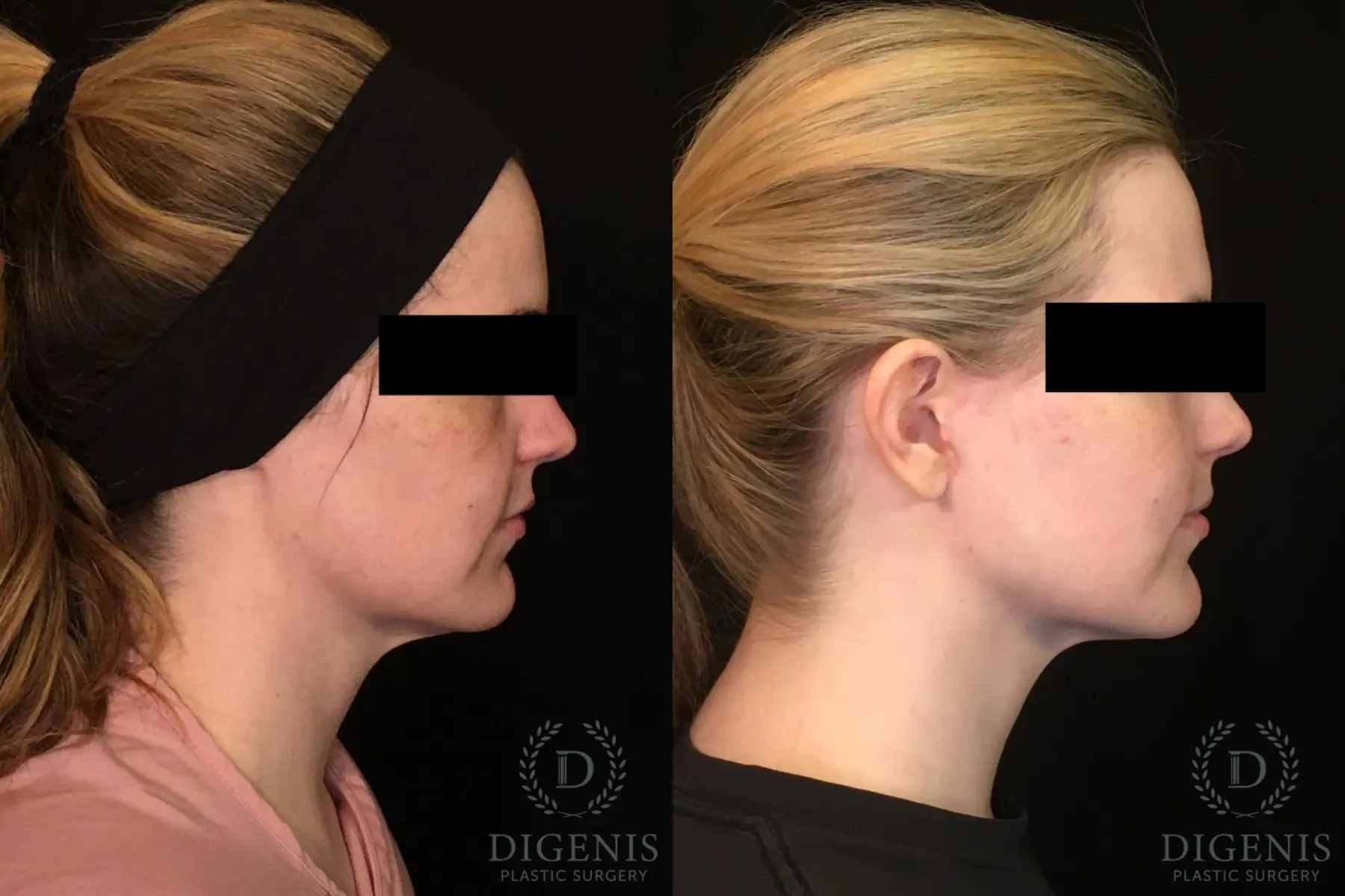 Digenis Refresh Lift: Patient 2 - Before and After 5