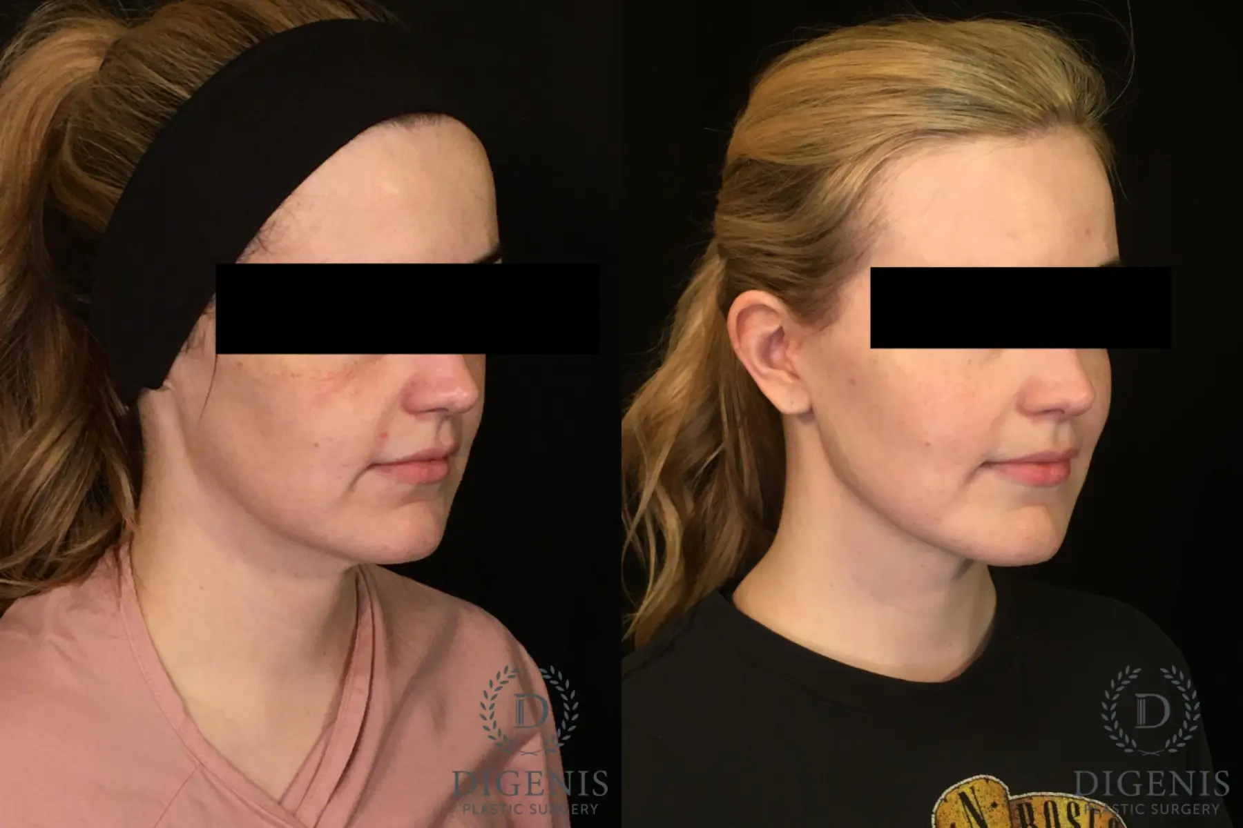 Digenis Refresh Lift: Patient 2 - Before and After 4