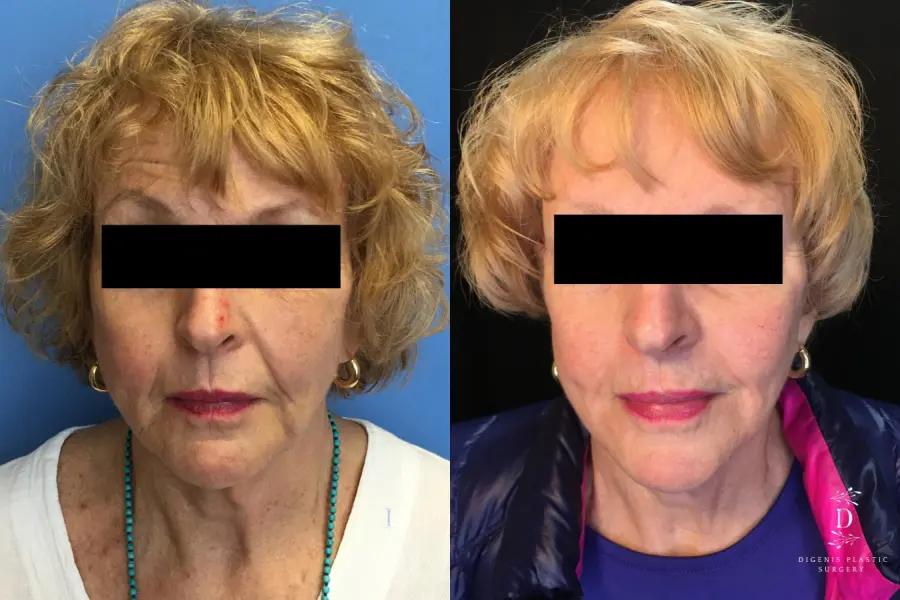 Digenis Refresh Lift: Patient 5 - Before and After  