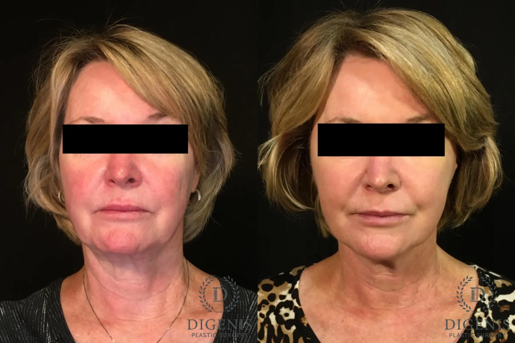 Digenis Refresh Lift: Patient 1 - Before and After 1
