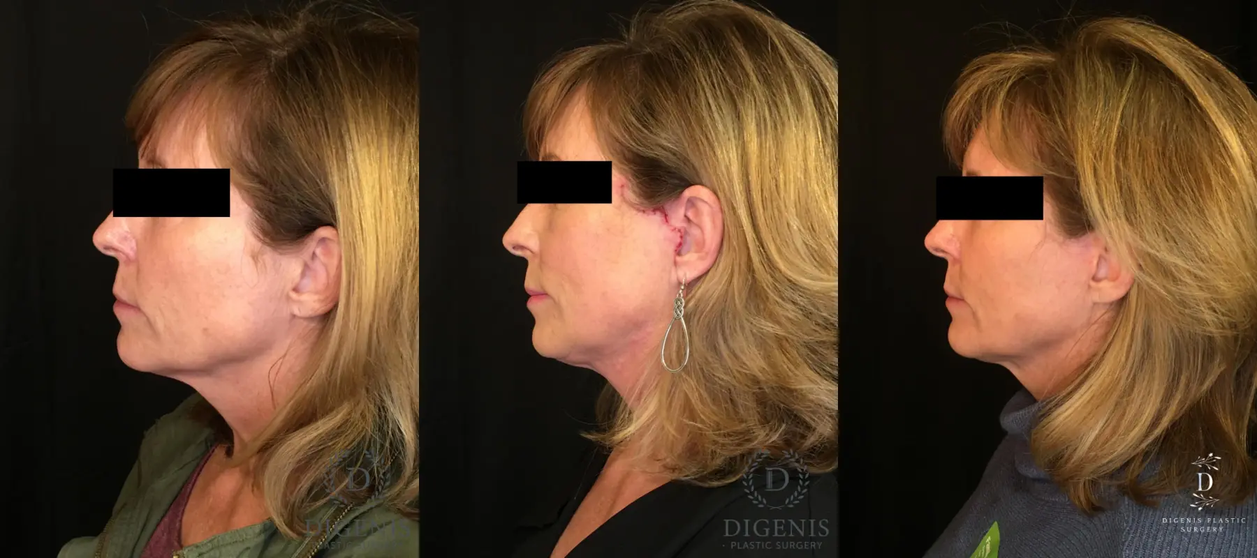 Digenis Refresh Lift: Patient 3 - Before and After 5