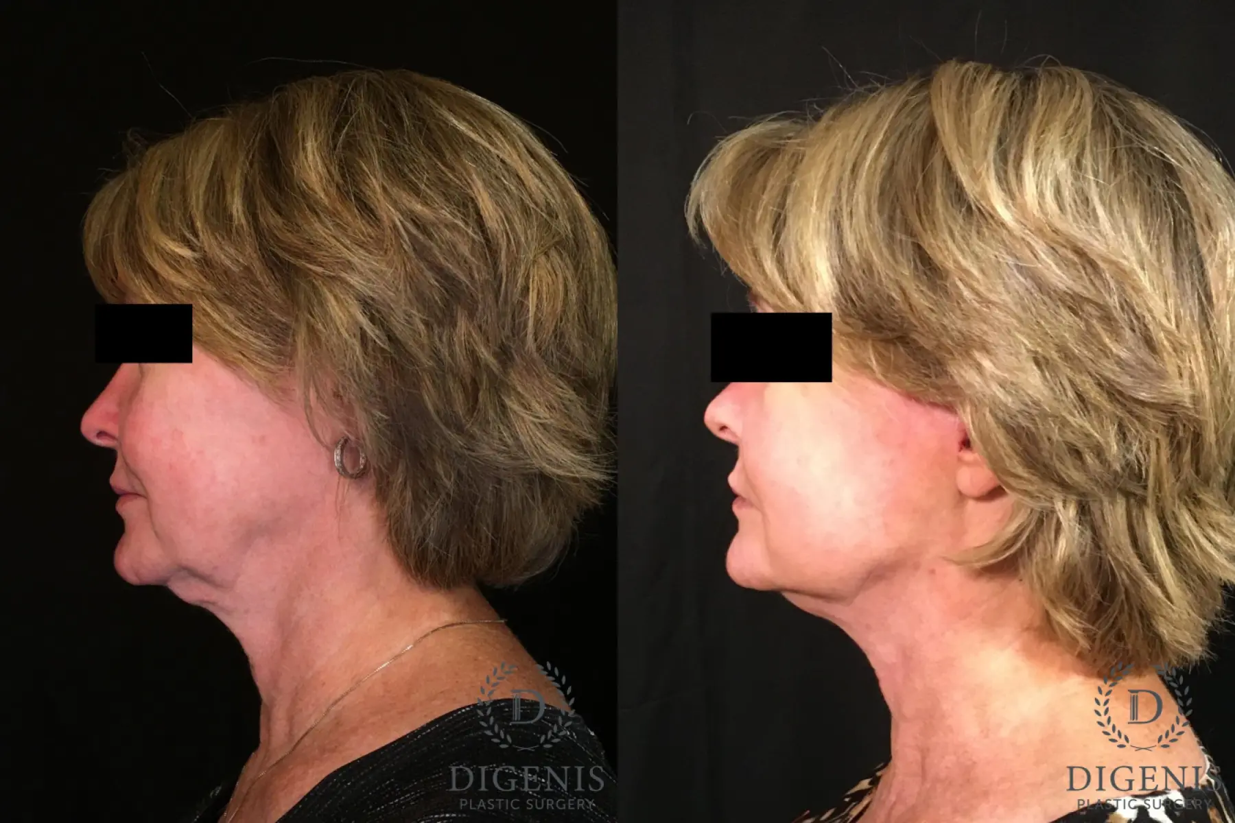 Digenis Refresh Lift: Patient 1 - Before and After 5