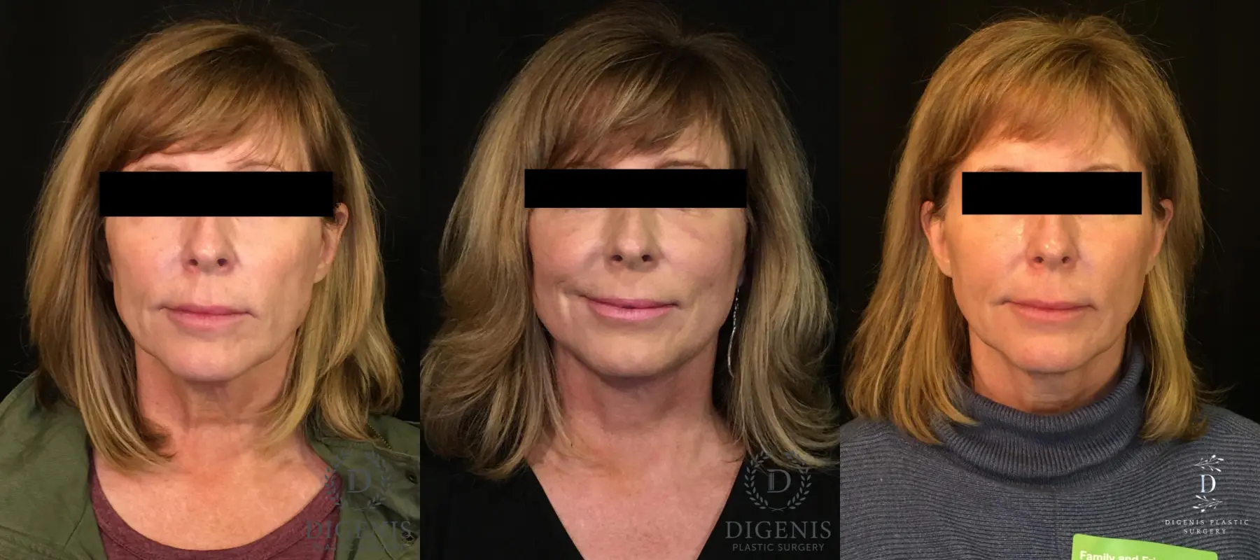 Digenis Refresh Lift: Patient 3 - Before and After 1