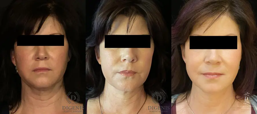Digenis Refresh Lift: Patient 4 - Before and After 1