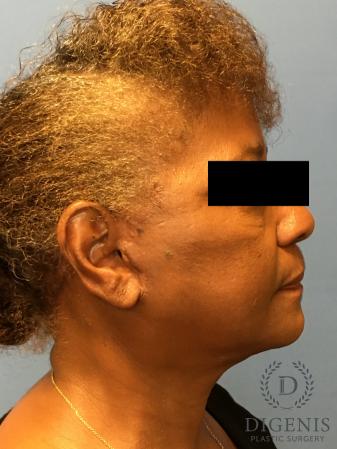 Facelift: Patient 8 - After 3